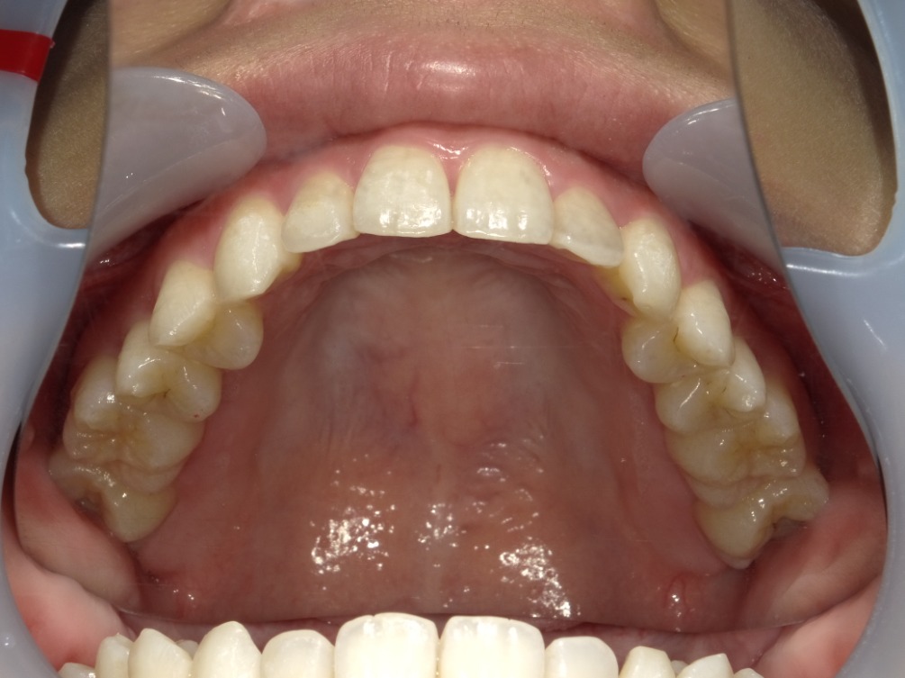 症例集 インビザライン 上顎