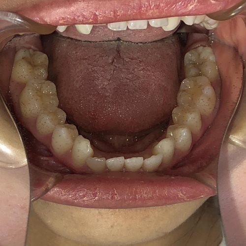 症例集 インビザライン 下顎