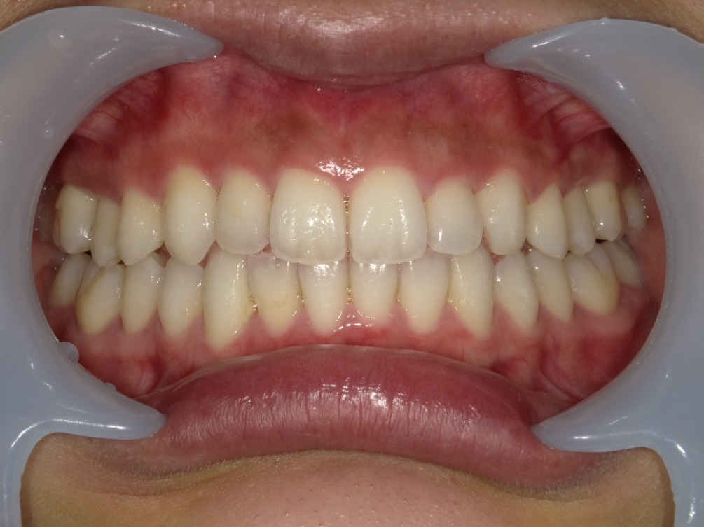 症例集 インビザライン 正面