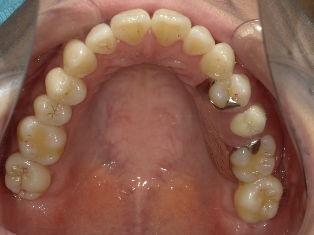 症例集 インビザライン 上顎