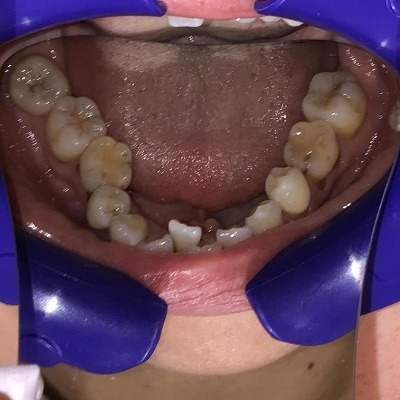 症例集 インビザライン 下顎