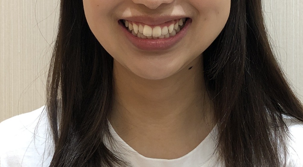 症例集 インビザライン 笑顔