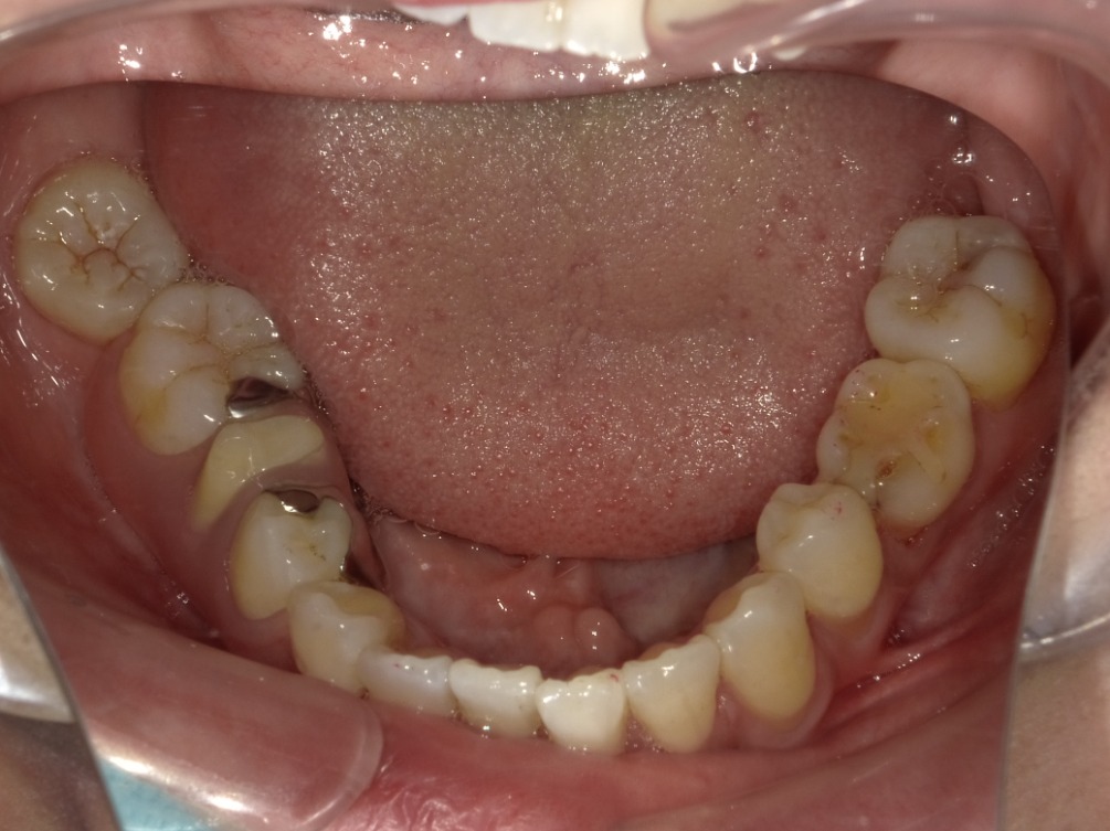 症例集 インビザライン 下顎