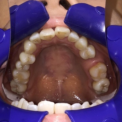 症例集 インビザライン 上顎