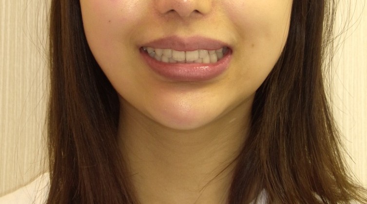 症例集 インビザライン 笑顔