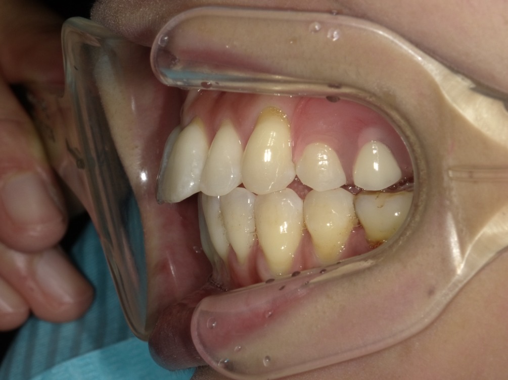 症例集 インビザライン 左横