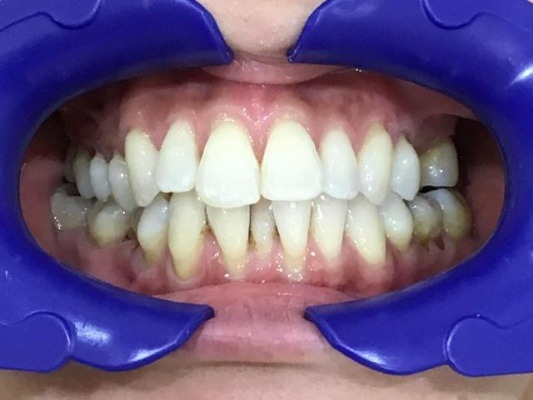 症例集 インビザライン 正面