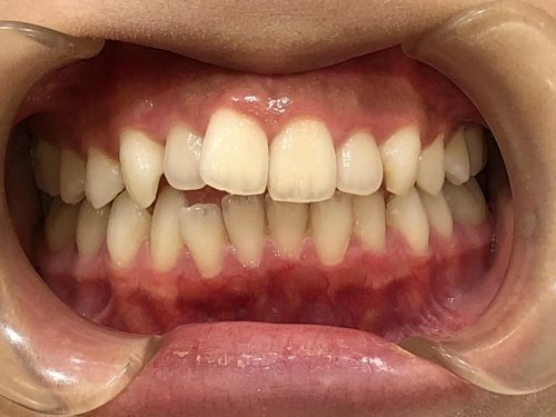 症例集 インビザライン 正面