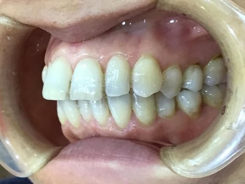 症例集　インビザライン　左横
