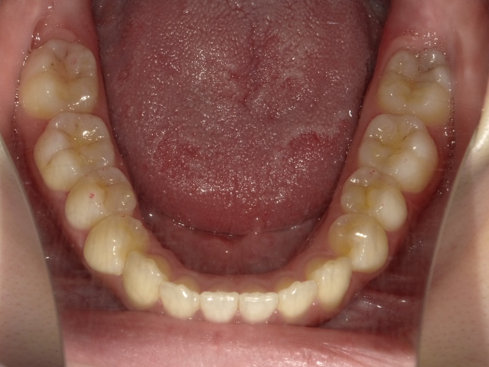 症例集　インビザライン　下顎