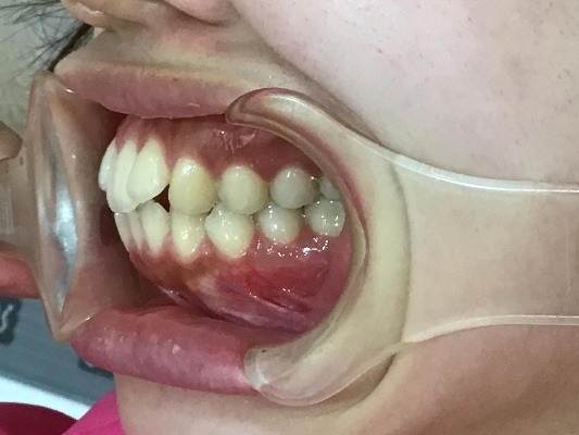 症例集　インビザライン　左横