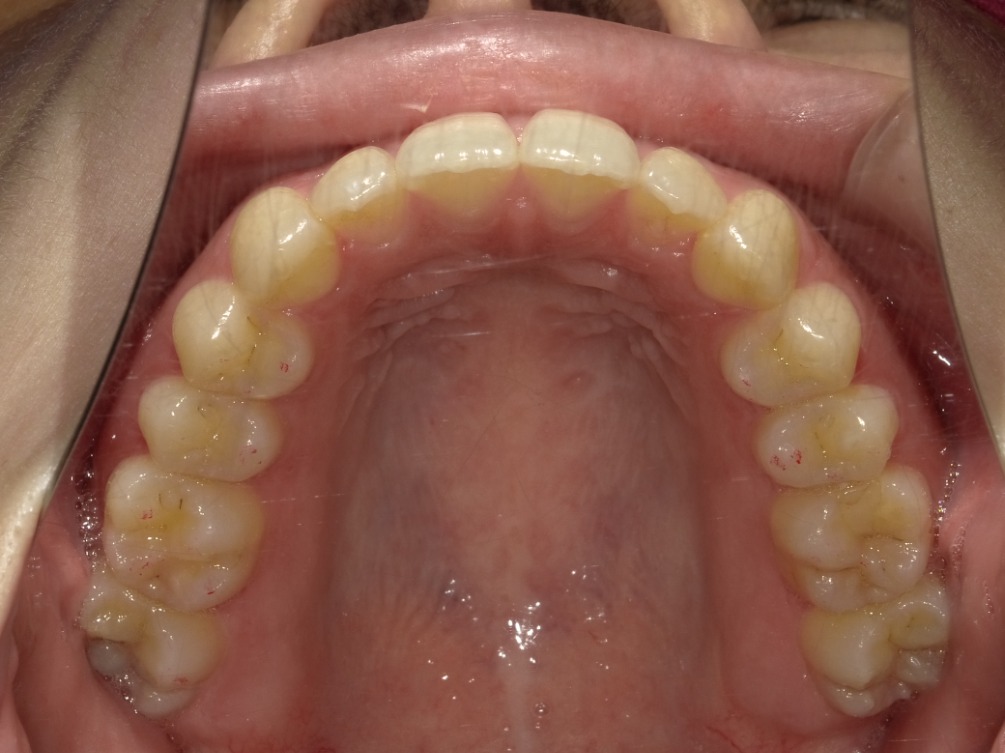 症例集　インビザライン　上顎