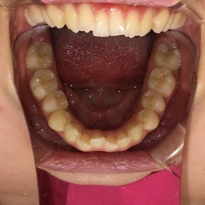 症例集　インビザライン　下顎