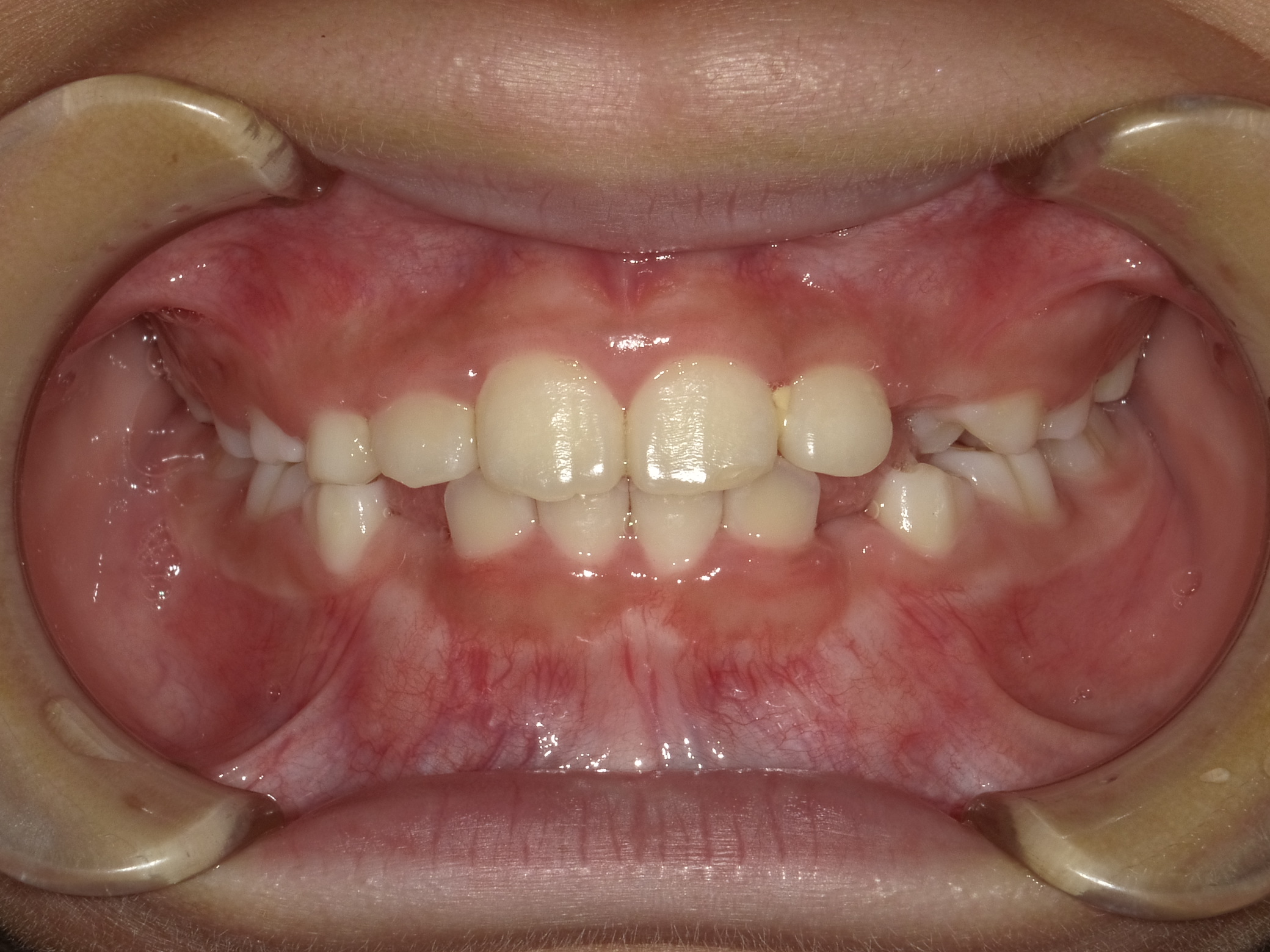 症例集 インビザライン 正面