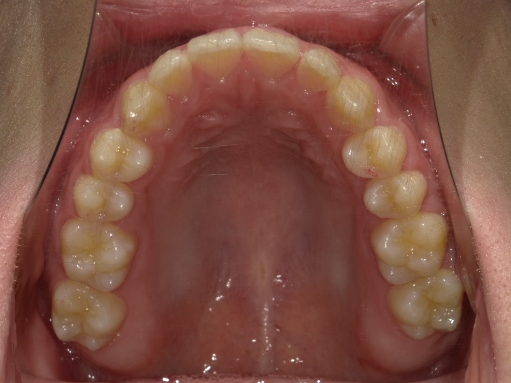 症例集　インビザライン　上顎