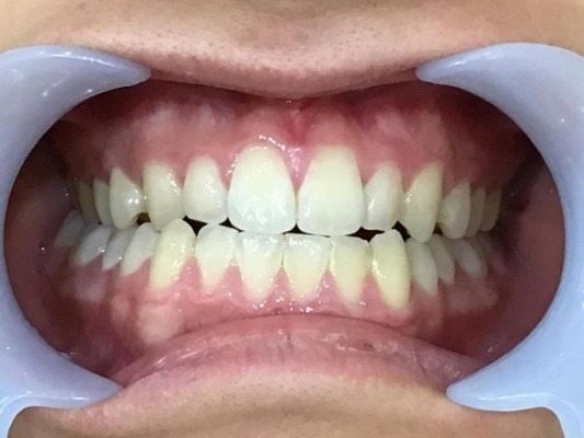 症例集　インビザライン　正面