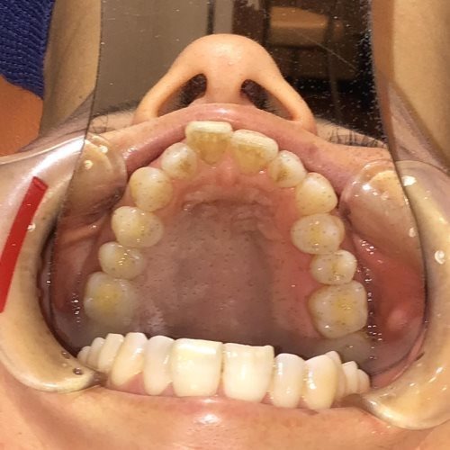 症例集　インビザライン　上顎