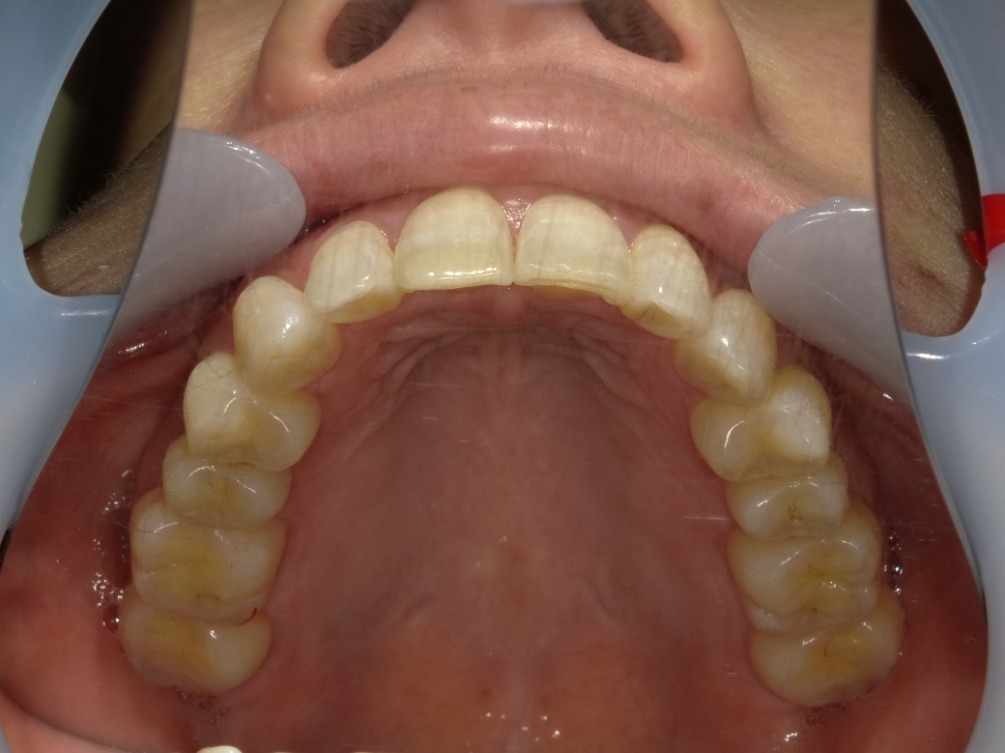 症例集　インビザライン　上顎