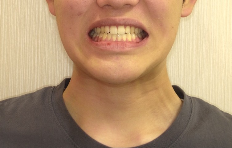 症例集　インビザライン　笑顔