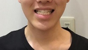 症例集　インビザライン　笑顔