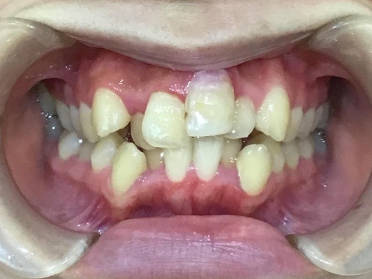 症例集 インビザライン 正面