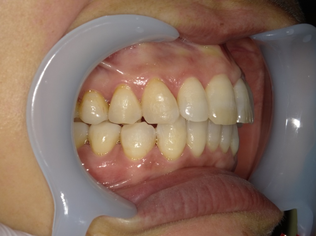 症例集　インビザライン　右横