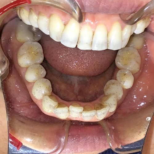 症例集　インビザライン　下顎