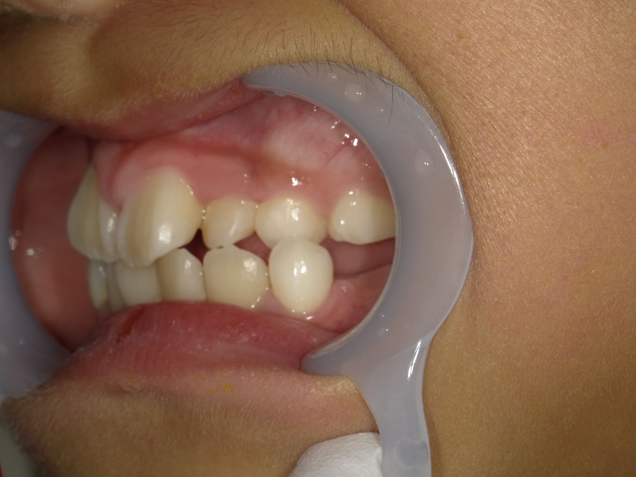 症例集 インビザライン 左横