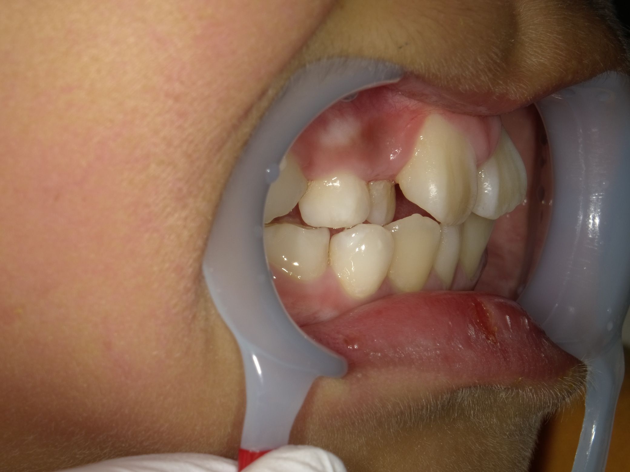 症例集 インビザライン 右横