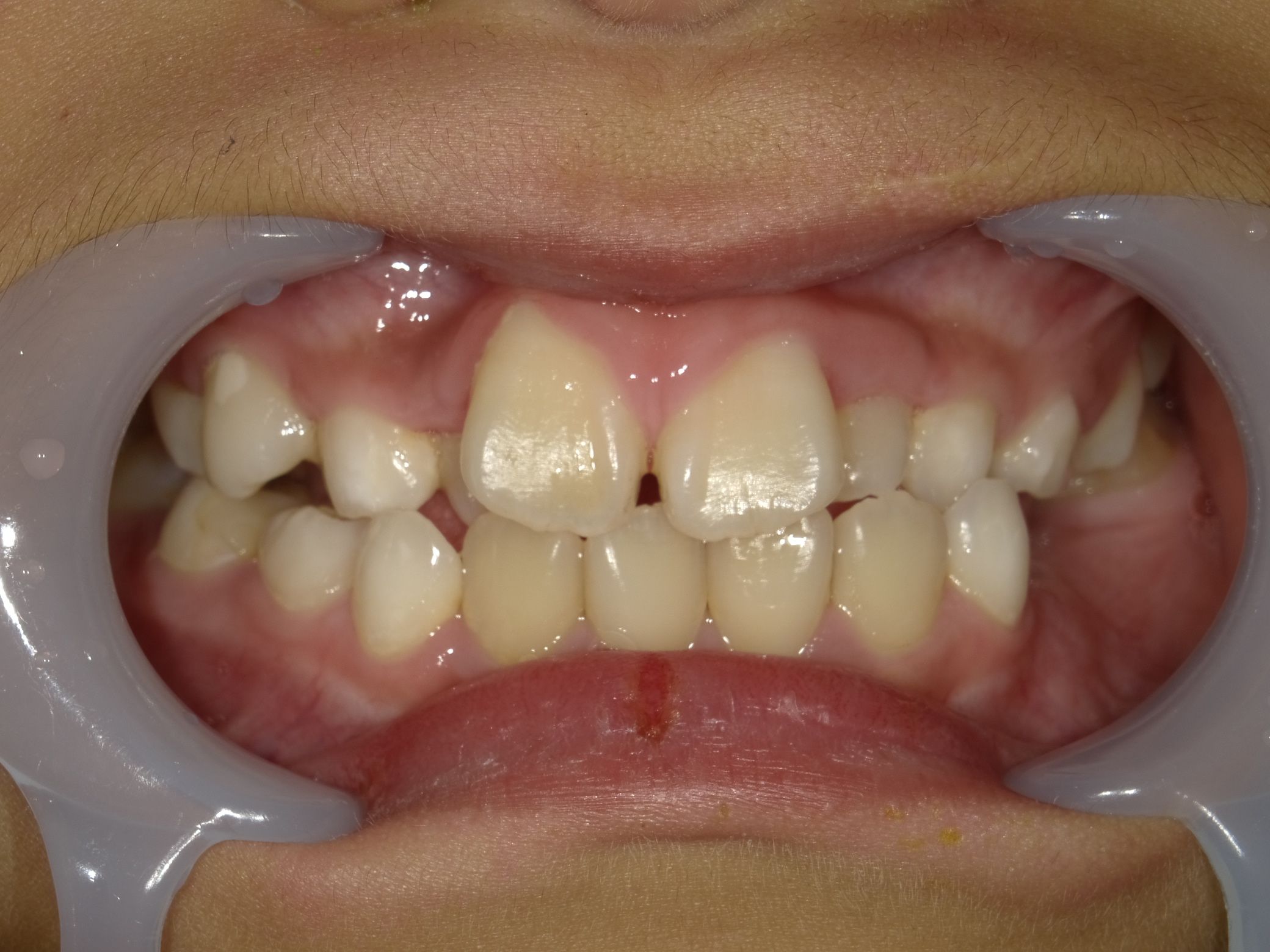 症例集 インビザライン 正面