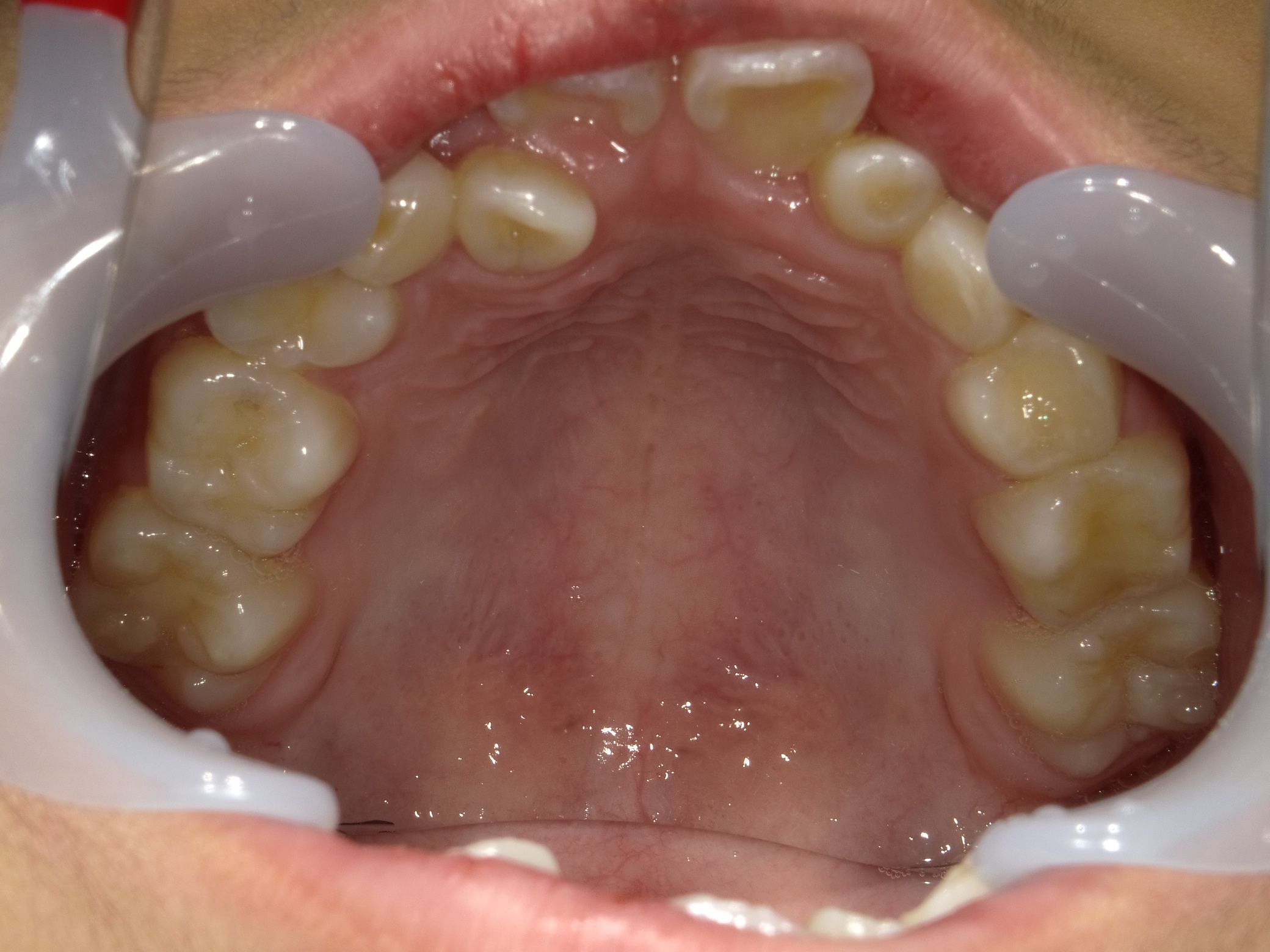 症例集 インビザライン 上顎