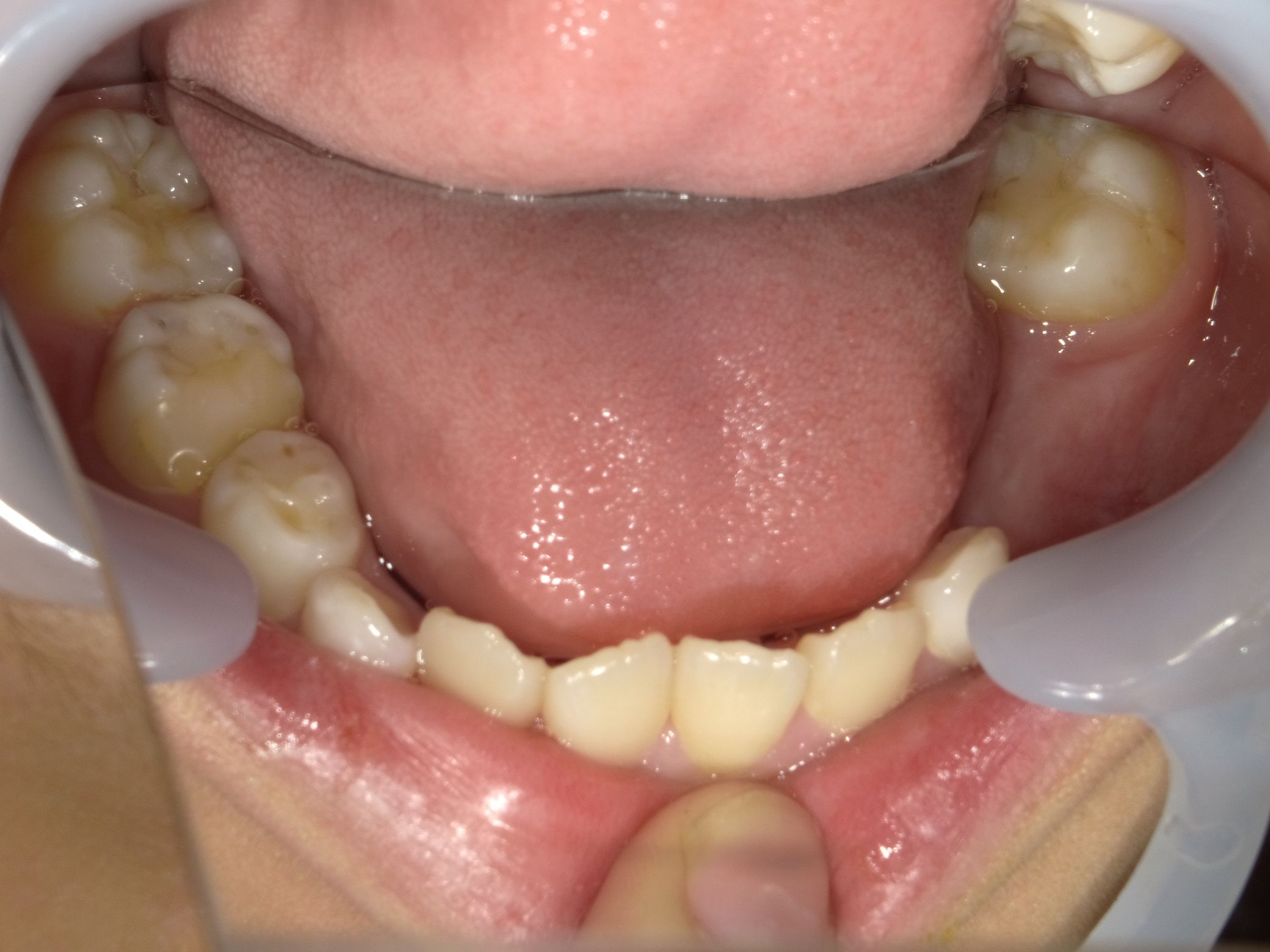 症例集 インビザライン 下顎