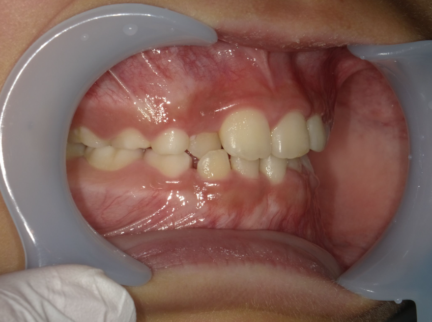 症例集　インビザライン　右横