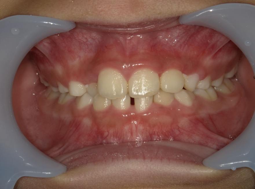 症例集 インビザライン 正面