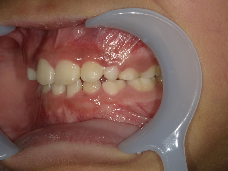 症例集 インビザライン 左横