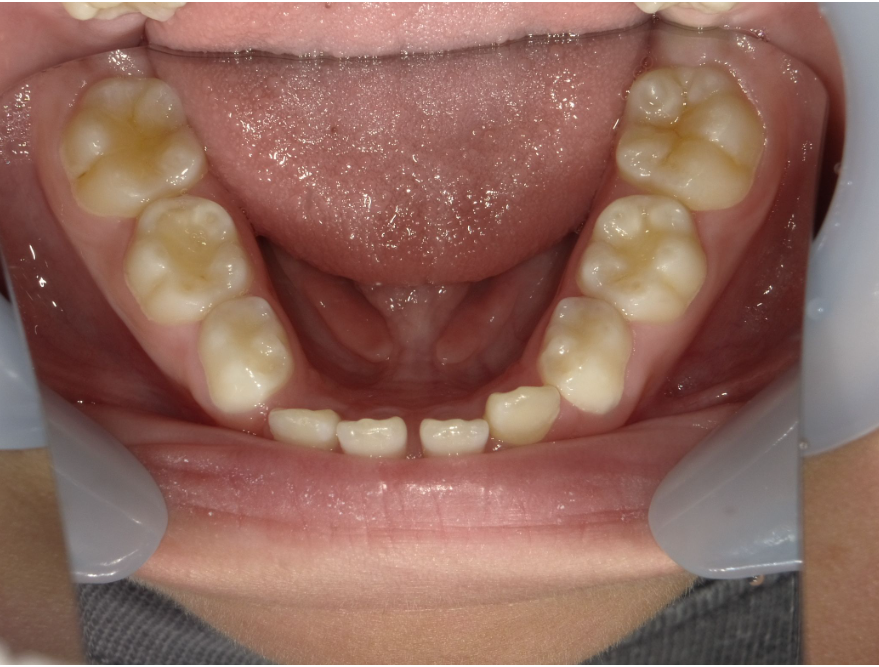 症例集 インビザライン 下顎