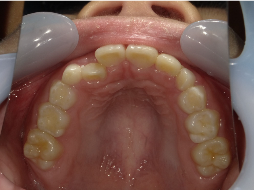 症例集 インビザライン 上顎