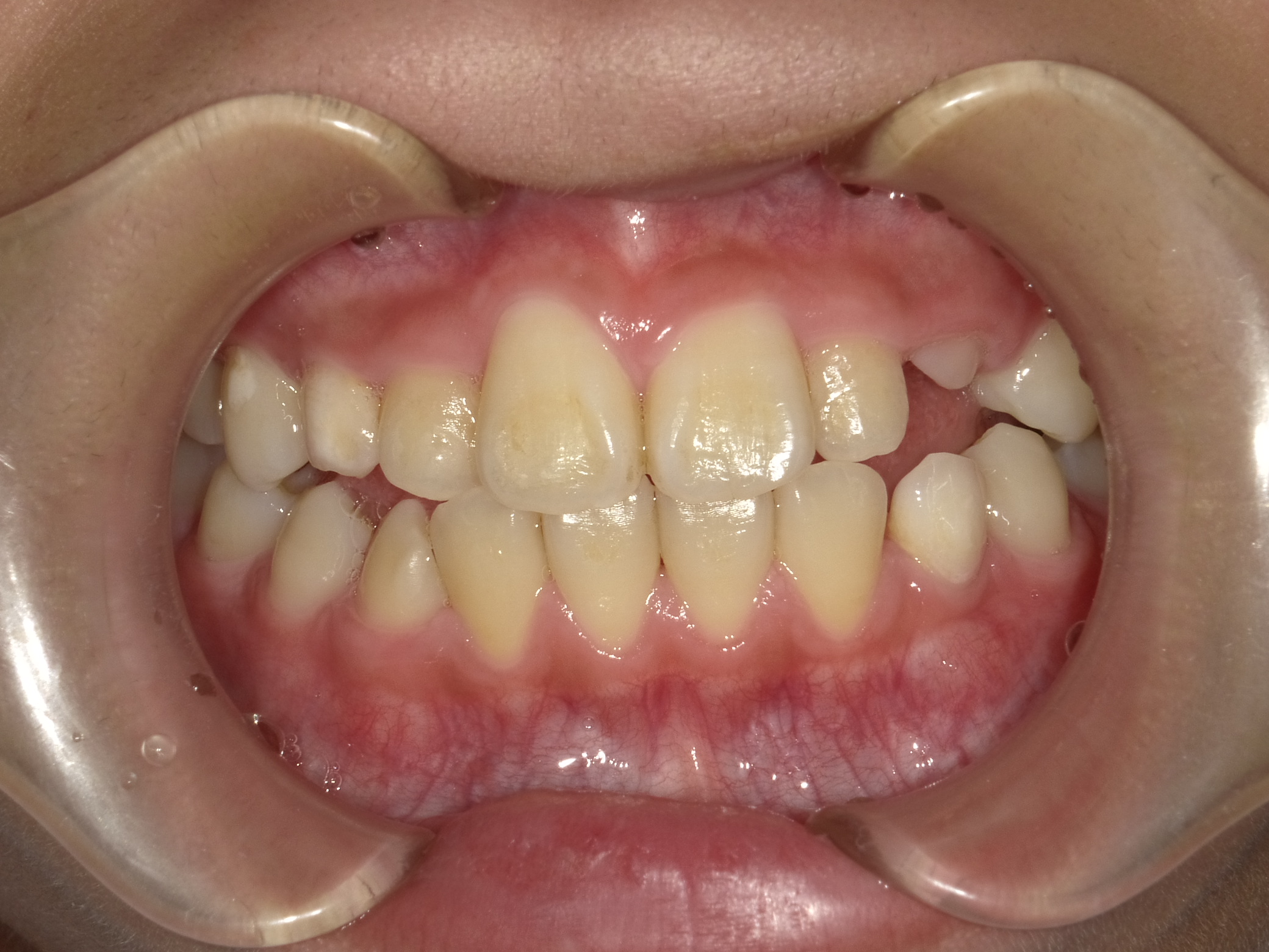 症例集 インビザライン 正面