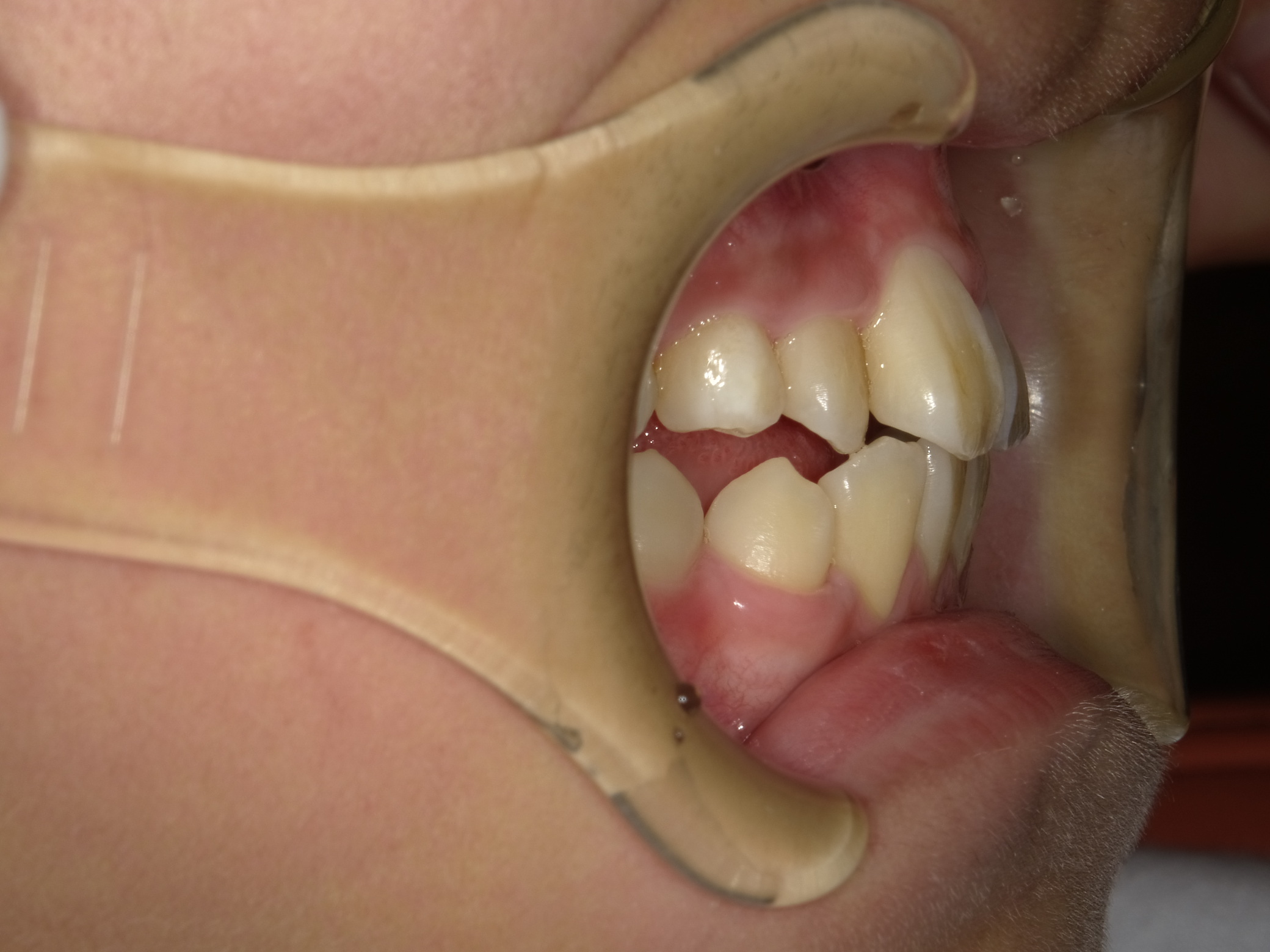 症例集 インビザライン 右横