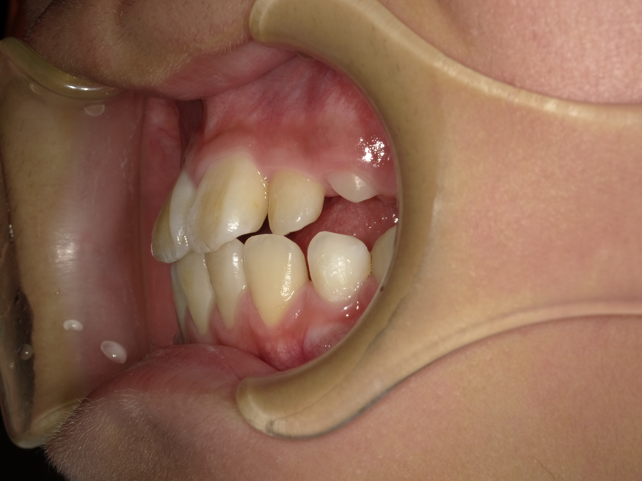 症例集 インビザライン 左横