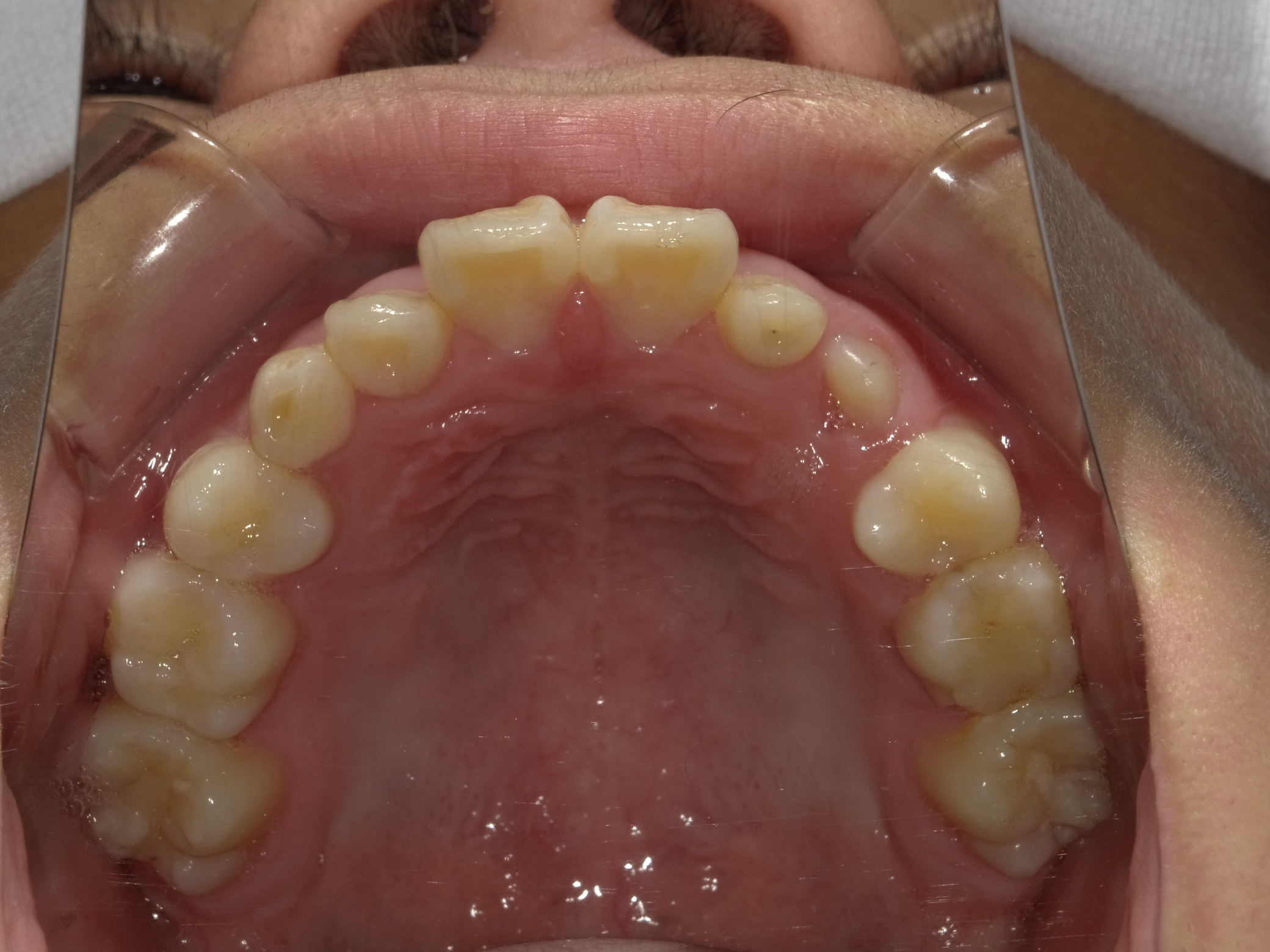 症例集 インビザライン 上顎