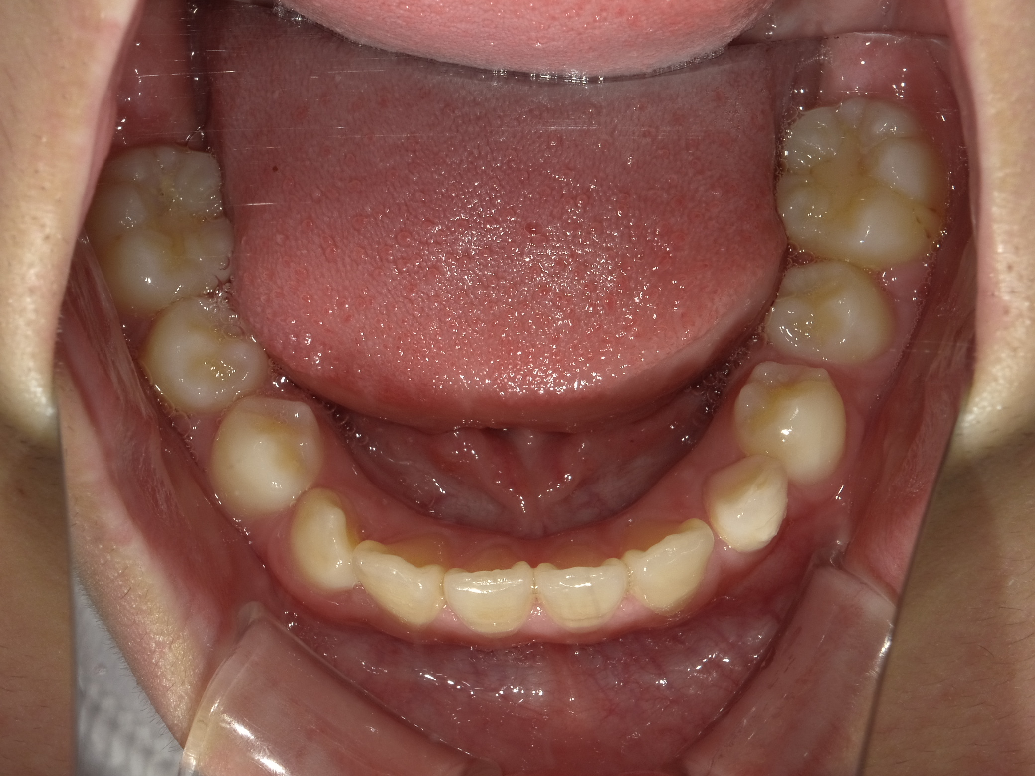 症例集 インビザライン 下顎