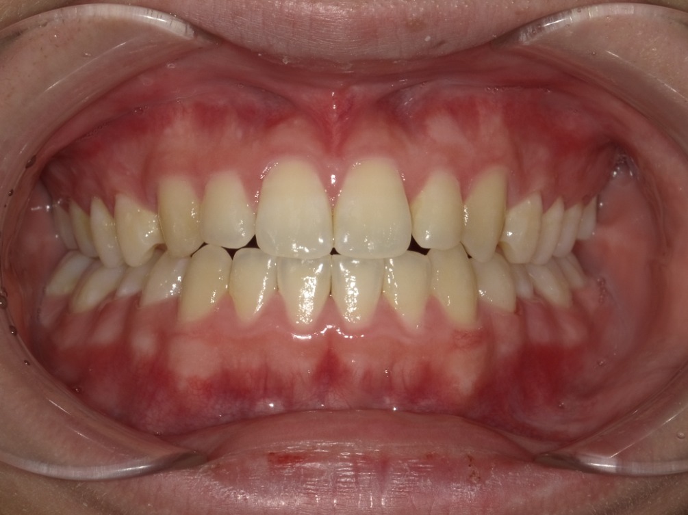 症例集　インビザライン　正面