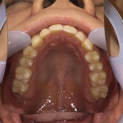 症例集　インビザライン　上顎