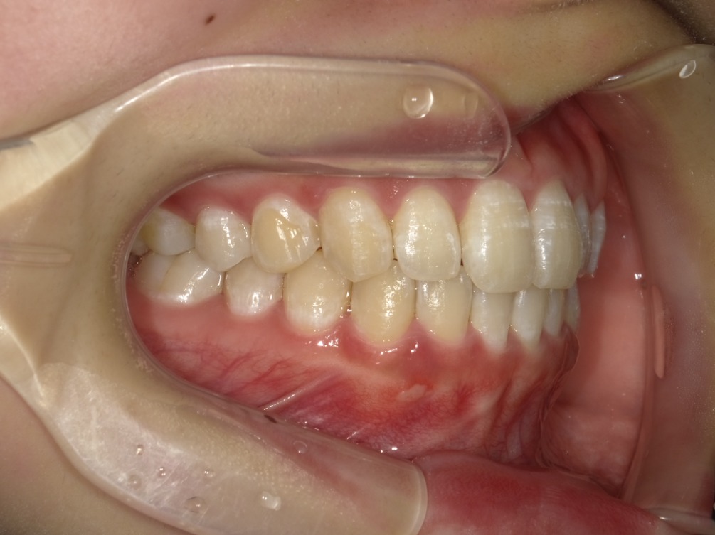 症例集　インビザライン　右横