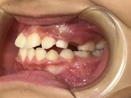 症例集　インビザライン　左横