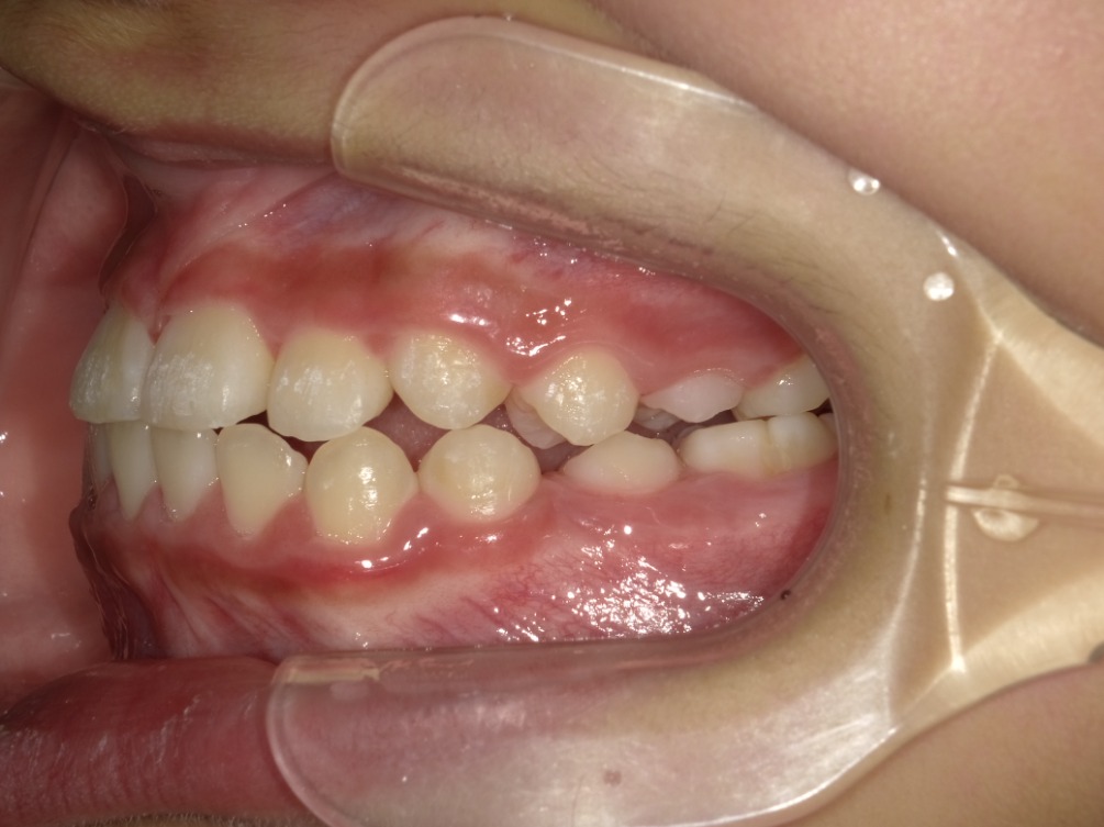 症例集　インビザライン　左横