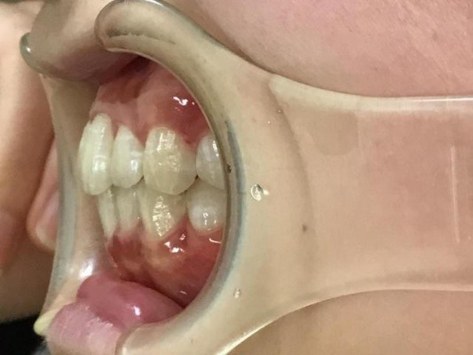 症例集　インビザライン　左横