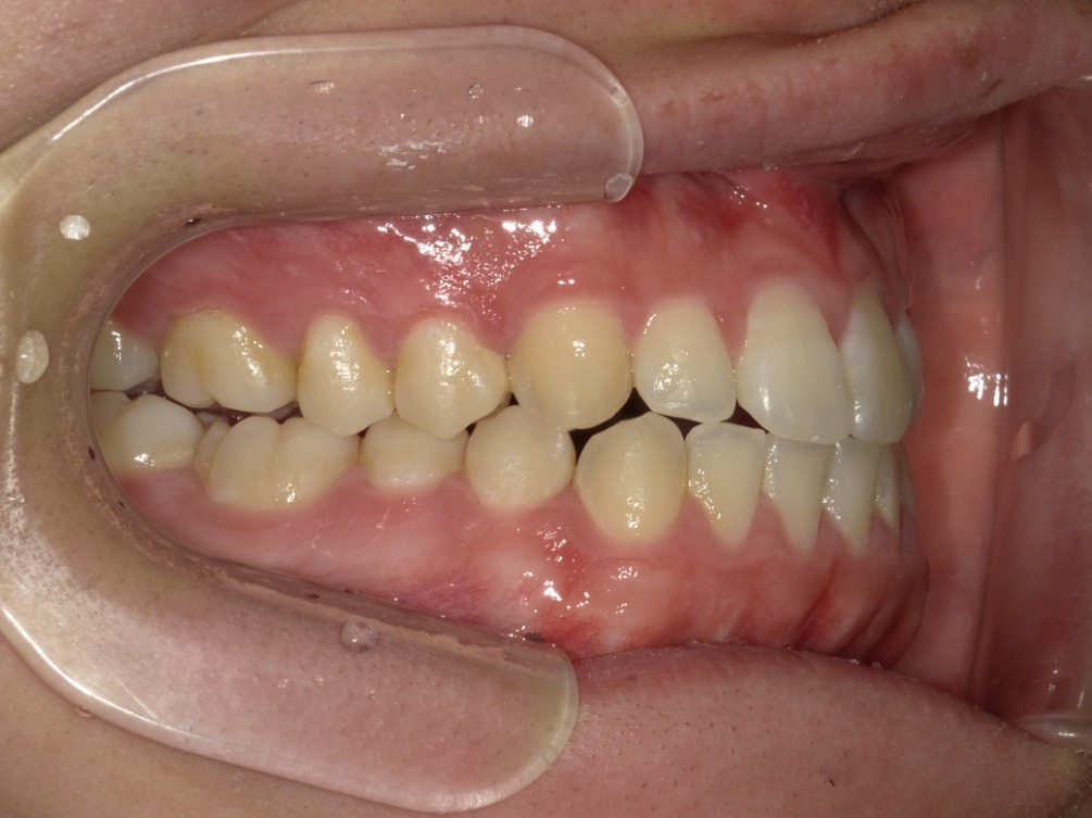 症例集　インビザライン　右横