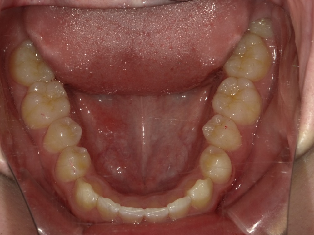 症例集　インビザライン　下顎